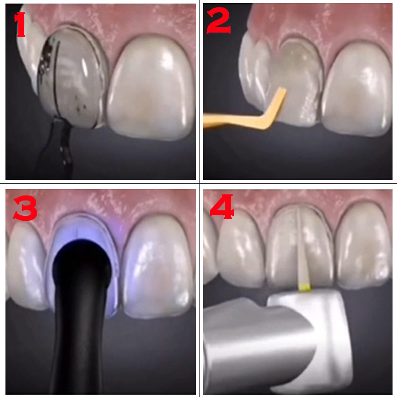 Kit da 32 Pezzi per Sbiancamen - Teeth Whitening Moulds recensione e prezzo
